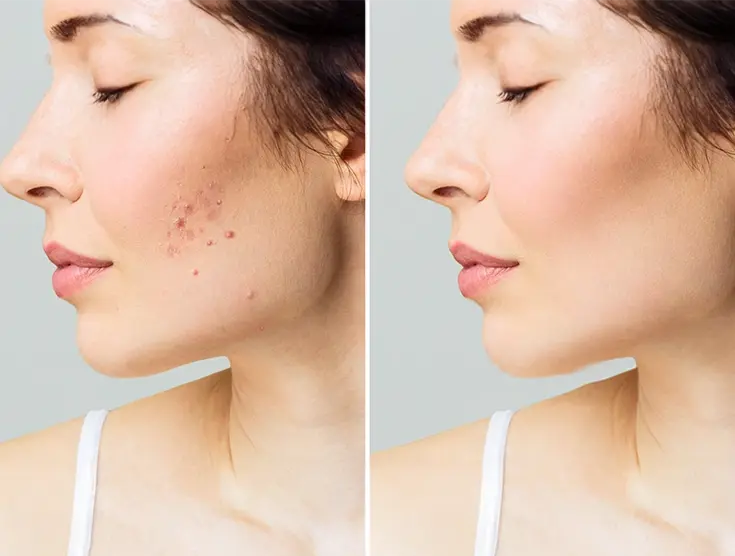 Acne & Scar Treatment