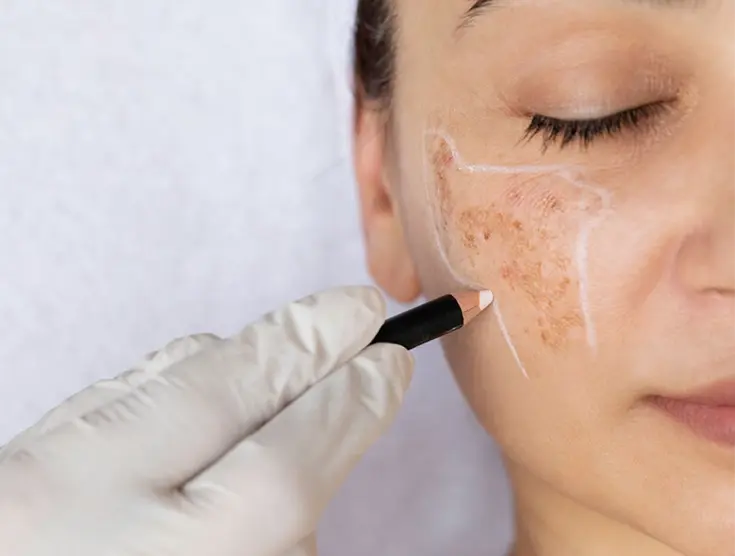 Pigmentation Treatment